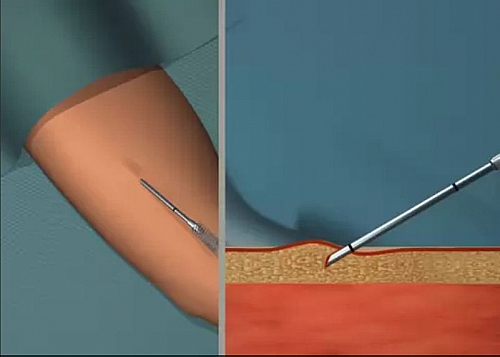 Insertion of Jadelle Implant