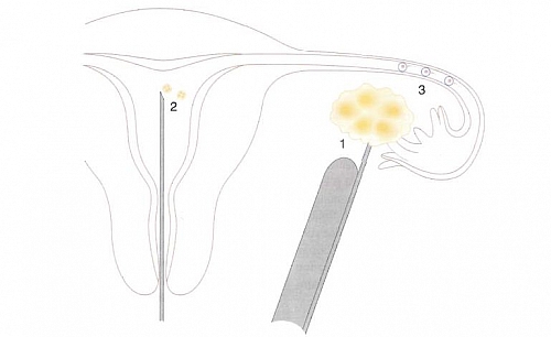 Transfer of embryo following fertilization and division during IVF