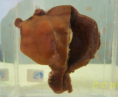 A preserved degenerated fibroid