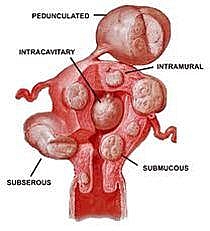Locations of different types of uterine fibroids