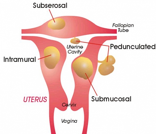 Common sites of fibroids in uterus
