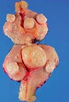 Photo of Fibroid removed during surgery Fibroid removed during surgery