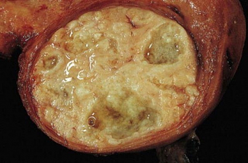 Uterine fibroid with cyst in the cavities