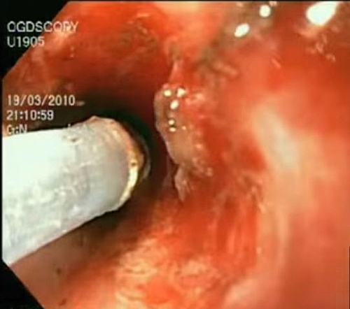 Endoscopy being done for diagnosis and therapeutic management of Gastrointestinal bleeding