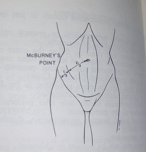 A sign of Appendicitis is tenderness at the McBurney point