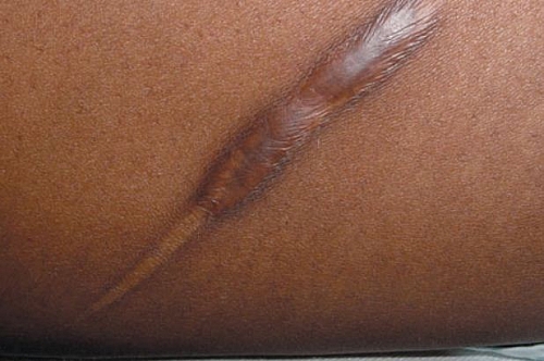 Picture of Hypertrophic scar. This type of scars occur as a result of wound healing that might have been complicated by infection