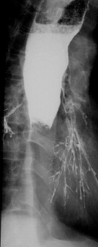 Complete obstruction to the flow of barium in this patient. The proximal oesophagus is dilated and there is a sharp cut off to the barium column characteristic for an impacted food bolus above a stricture. In this patient barium has aspirated into the bronchial tree and is outlining the lower lobe bronchi. This is not a serious complication unless gastrografin contrast has been used instead of barium