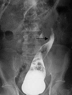 Chronic sigmoid volvulus on barium enema showing tapering of the contrast column at the level of the twisting bowel