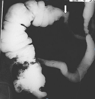 Photo of Colitis involving the distal transverse colon and descending colon. There is marked narrowing with loss of haustrations. The ascending and proximal transverse colon appear normal. The transition from normal to abnormal is clearly distinguishable due to sudden change in calibre. There are no visible ulcers suggesting that the disease is not in active phase although because this is a single contrast study superficial ulceration may not be seen Colitis involving the distal transverse colon and descending colon. There is marked narrowing with loss of haustrations. The ascending and proximal transverse colon appear normal. The transition from normal to abnormal is clearly distinguishable due to sudden change in calibre. There are no visible ulcers suggesting that the disease is not in active phase although because this is a single contrast study superficial ulceration may not be seen