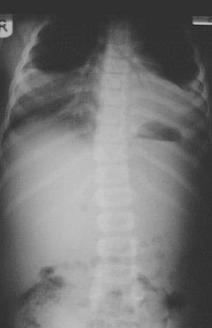 An erect abdominal film in a 12 year old child.  He was admitted with abdominal pain several days after falling out of a tree.  Splenic rupture was suspected but this X-ray shows bilateral consolidation in the lower lobes.  Note that there is a silhouette sign of both heart borders and the L diaphragm. The bilateral lower lobe pneumonia was the cause of the abdominal pain