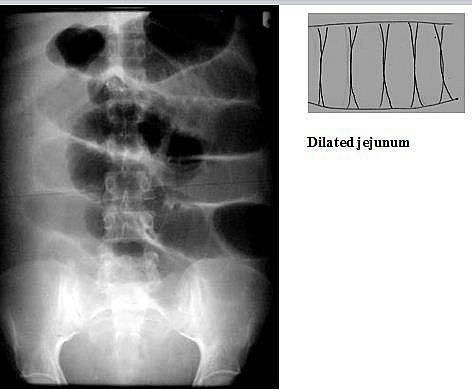 Small bowel obstruction showing dilated loops of small bowel recognised by valvulae conniventes in the jejunum.  The bowel is lying centrally.