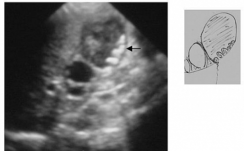 Acute cholecystitis on ultrasound. The gallbladder contains 6 visible stones on this image. Its lumen is filled with echogenic material consistent with inflammatory exudate & was acutely tender on palpation
