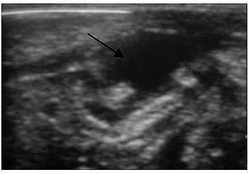 Large appendix abscess collection seen with abdominal ultrasound scan