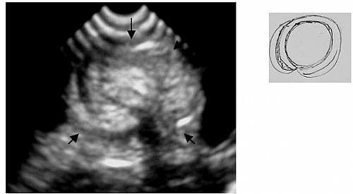 A young child admitted with abdominal pain & constipation of 3 days duration. There was a history of passing bloody stools. An ultrasound scan was performed which showed a bowel related mass with appearance similar to a bulls eye target lesion. This was due to an intussusception.