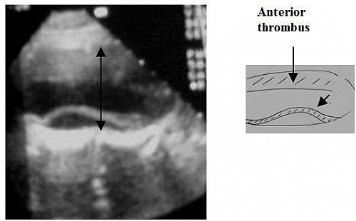 Longitudinal ultrasound scan of the abdomen showing an aortic aneurysm. The aorta is very dilated measuring 5.5cm. The normal aorta measures 1.5cm diameter just above its bifurcation. There is clot anteriorly. Posteriorly there is a flap of tissue lying within the lumen. This is due to dissection of the intima. The patient was admitted with abdominal pain radiating to the back due to acute dissection of an existing aortic aneurysm.(B) small image shows: Intima which is displaced anteriorly by posterior dissection.