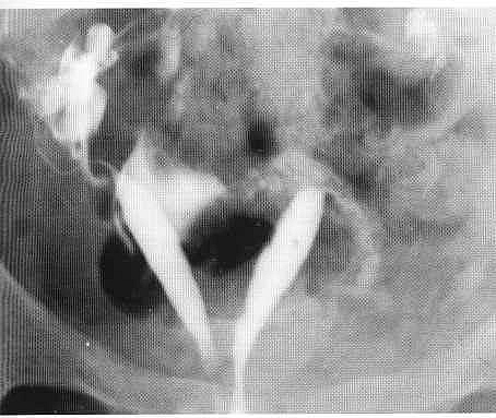 Photo of Hysterosalpingography showing Uterus bicornis bicollis Hysterosalpingography showing Uterus bicornis bicollis