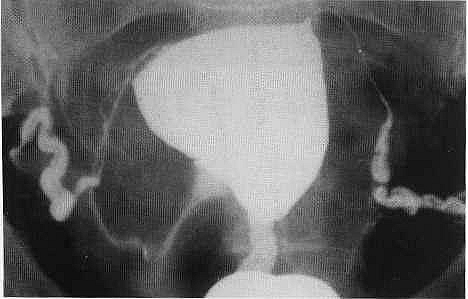 Uterine Fibroid seen with Hysterosalpingography