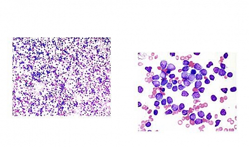 Photo of ALL in Peripheral blood film ALL in Peripheral blood film