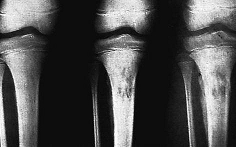 X ray film of Acute Osteomyelitis affecting the Tibia