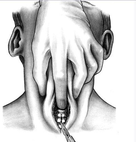 Photo of Tracheostomy Procedure: A Vertical incision made on the anterior aspect of the neck Tracheostomy Procedure: A Vertical incision made on the anterior aspect of the neck
