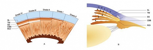 Cross Section of the Eye showing the different Glaucoma Angles used in the Shaffer