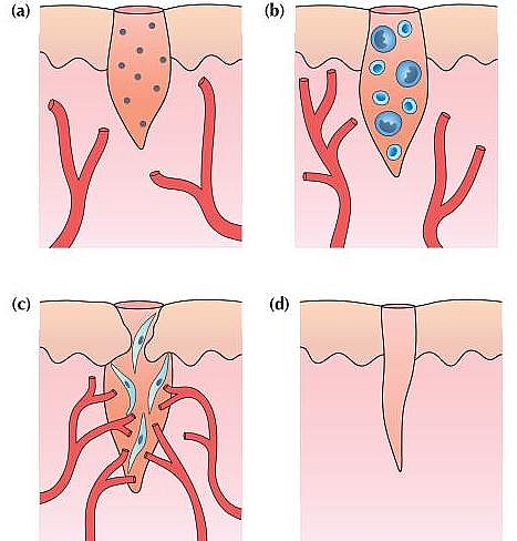 The phases of healing. (a) Early inflammatory phase with platelet-enriched blood clot and dilated vessels. (b) Late inflammatory phase with increased vascularity and increase in polymorphonuclear lymphocytes (PMN) and lymphocytes (round cells). (c) Proliferative phase with capillary buds and fibroblasts. (d) Mature contracted scar.