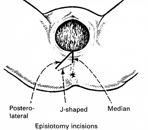 Different types of Episiotomy incisions