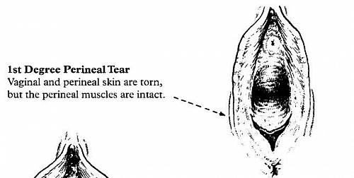 First degree perineal tear