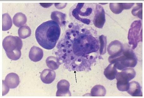 Diagnosis of Leishmaniasis: The amastigotes of leishmania seen in the bone marrow cells