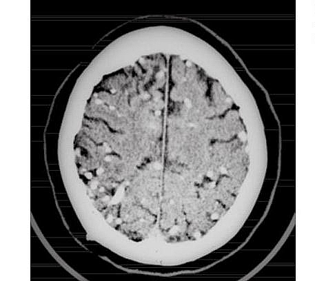 Cysticercosis affecting the brain: Cysticerci seen as lesions
