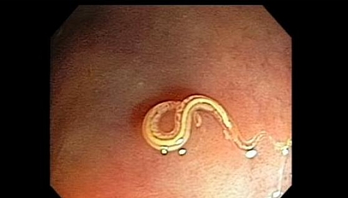 Whipworm seen in the colon during Colonoscopy