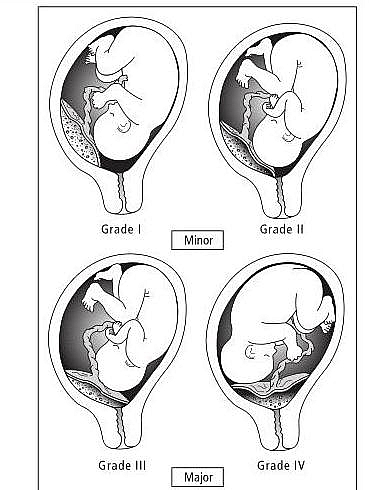 Placenta previa types: Major and Minor Placenta praevia