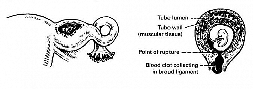 Tubal pregnancy - the commonest type of Ectopic Pregnancy