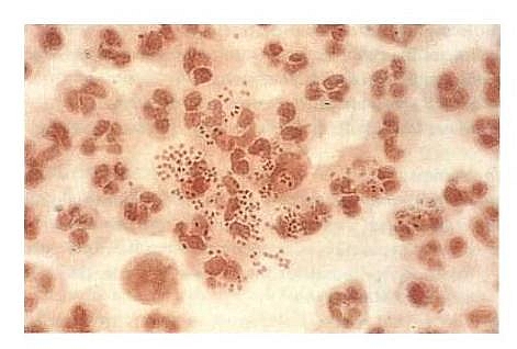 Neisseria gonorrhoeae (gram negative intracellular diplococci) - causative agent of Gonorrhea