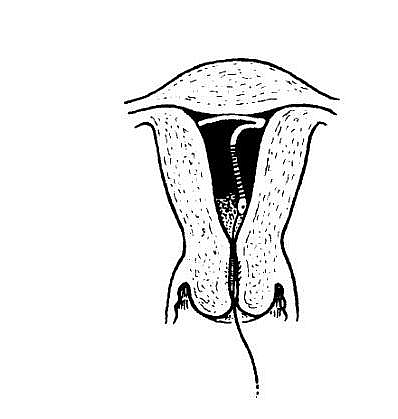 4. Inserted Copper T in the uterus
