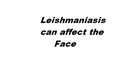 Ulceration of the Face could occur due to Mucocutaneous leishmaniasis