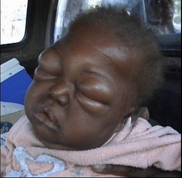 Photo of Kwashiorkor: Causes, Symptoms, Treatment and Complications