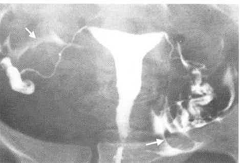 Photo of Hysterosalpingogram (HSG) Procedure, Indications, Contraindications and Complications