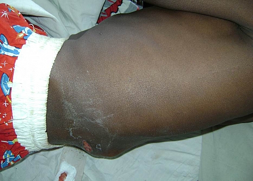 Photo of Pott disease (TB Spine) Symptoms, Causes, Treatment guidelines and Prevention