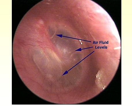 Photo of Otitis Media with Effusion (Glue ear) Symptoms, Causes, Treatment and Pictures