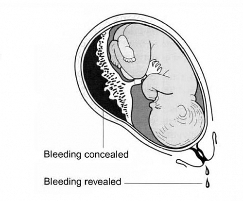 Photo of Placental Abruption: Abruptio Placentae Causes, Symptoms, Signs, Types and Treatment