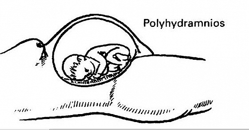 Photo of Polyhydramnios Causes, Symptoms, Treatment, Risk factors and Treatment